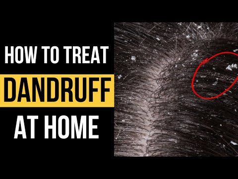 Doctor explains HOW TO TREAT DANDRUFF AT HOME and 5...