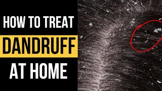 Doctor explains HOW TO TREAT DANDRUFF AT HOME and 5 different anti-dandruff shampoos to use...