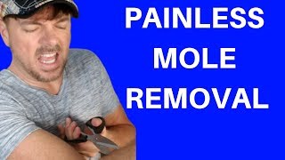 BEST WAY TO REMOVE MOLES | SKIN TAGS TOO! | Chris Gibson