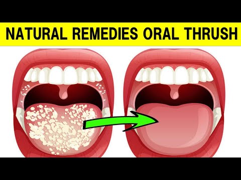 , title : 'How To Treat Oral Thrush With Natural Remedies'
