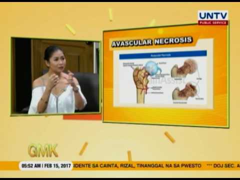 Usapang Pangkalusugan: Dr. Pebbles talks about Avascular Necrosis (Osteonecrosis)