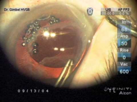 Membrane Optic Capture For Sunset Syndrome