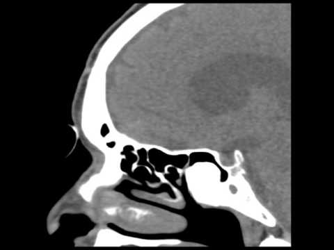 Sinus Osteoma