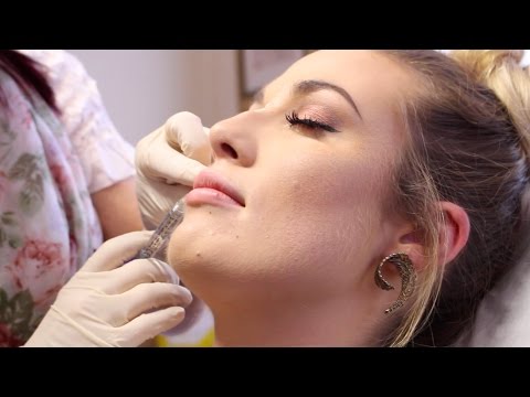 Lip Enhancement Demonstration Using Dermal Filler