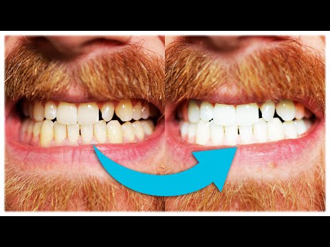 WEISSE ZÄHNE in 10 Minuten!? | Zahnaufhellungskit Test (dm)