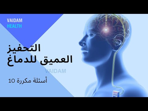 الأسئلة المتداولة حول التحفيز العميق للدماغ