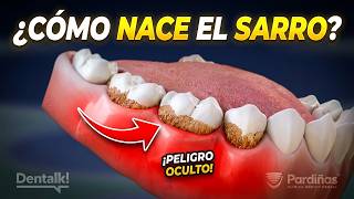 ¿Cómo se forma el sarro? El proceso detrás de tus encías inflamadas