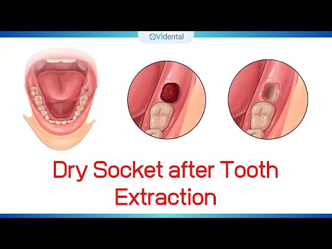 ► Dry socket after tooth extraction (Oral Surgery)
