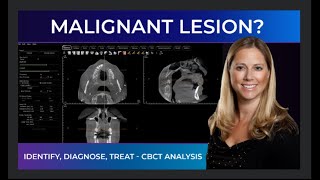 Interpret and Diagnose Malignant Lesions with CBCT | Case Bites