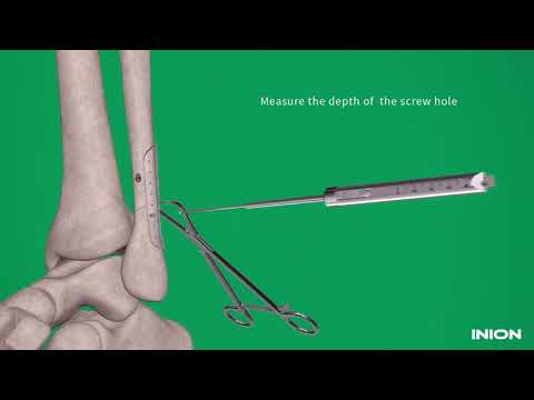 INION Freedom System   Ankle Fracture Repair Animation