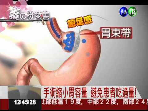 終極減肥法! 胃束帶1年瘦55公斤