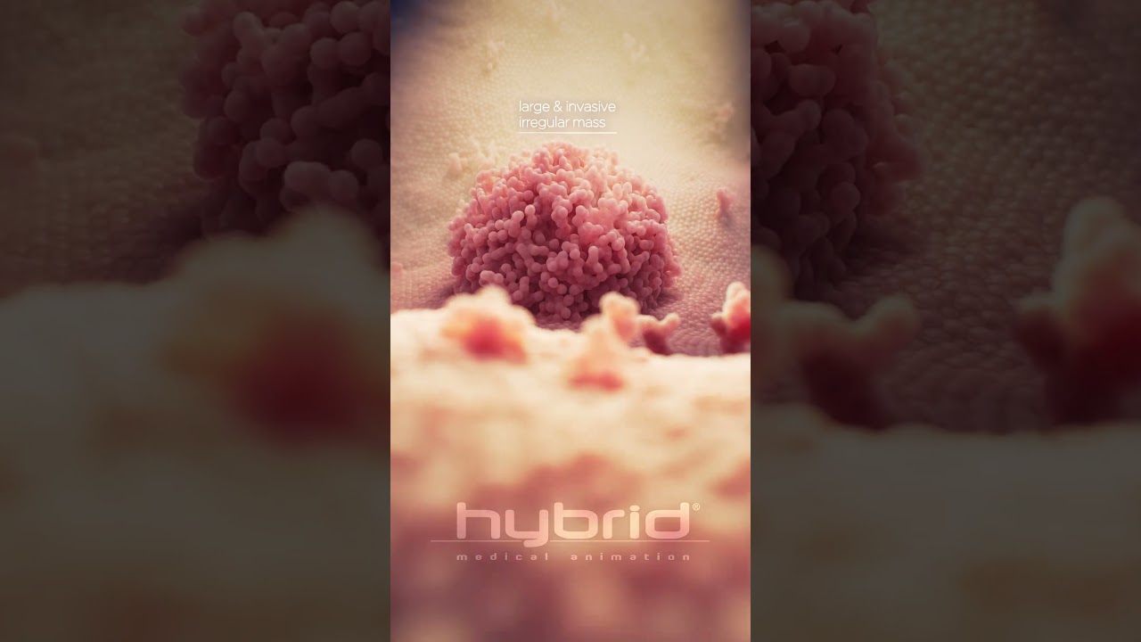 Bladder cancer animation | papillary carcinomas | #bladdercancer #cancer #medicalanimation