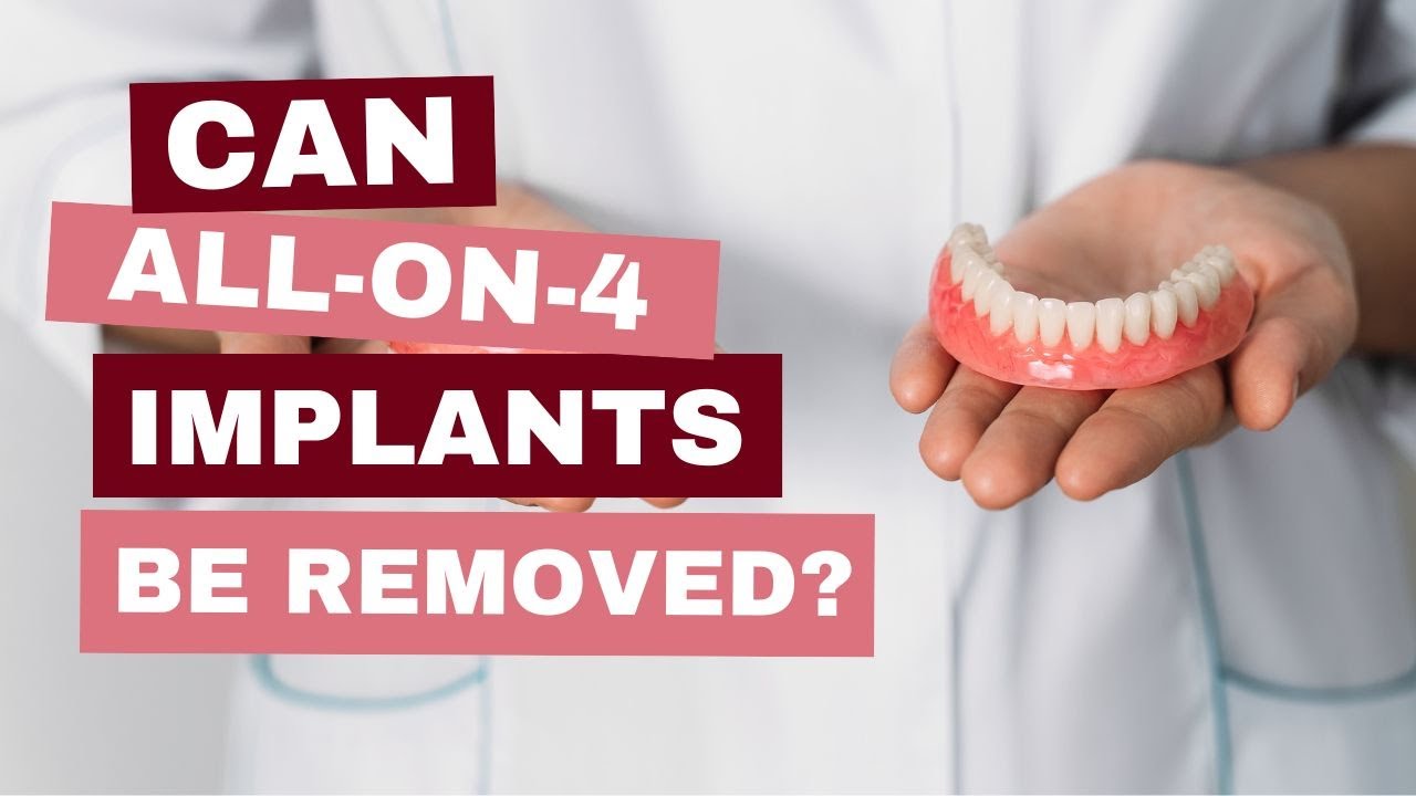 Can All-On-4 Implants Be Removed?