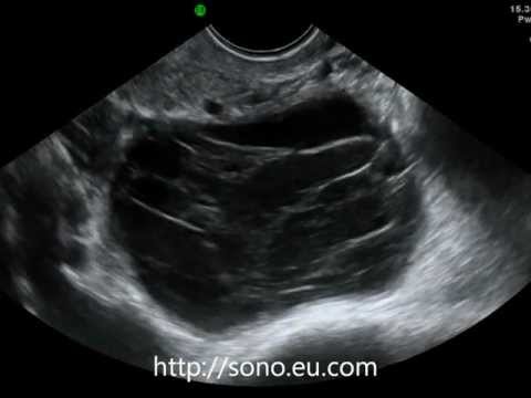 Torbiel krowtoczna jajnika widoczna w ultrasonografii przezpochwowej