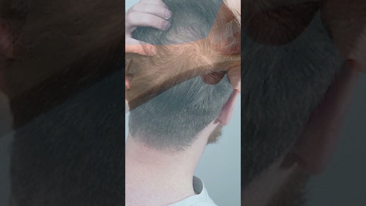 How Long Does It Take For Alopecia To Go Away? | Alopecia | Stem Cell Injection for Hair Loss