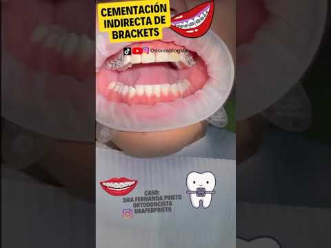 Cementación indirecta de brackets 😬