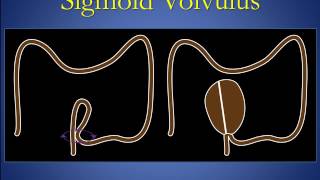 Cecal and sigmoid volvulus version 1 0 edit Cecal and sigmoid volvulus version 1 0 edit