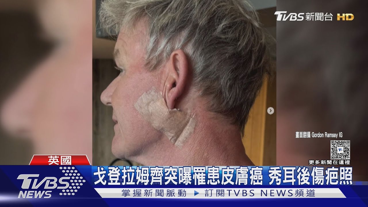「地獄廚神」戈登拉姆齊曝罹皮膚癌!布魯斯威利「失智症」加重搬離住居