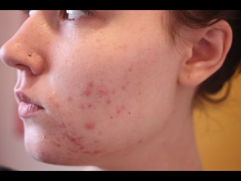 comment traiter l'acné chez l'adulte