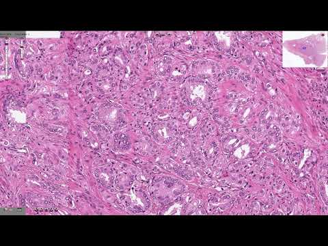 Prostate adenocarcinoma gleason score 9