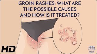Solving the Mystery of Groin Rashes: What You Need to Know