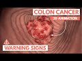 5 Warning Signs Of Colon Cancer 3D Animation