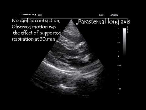 Emergency Point Of Care Ultrasound  In  Ruptured Abdominal Aorta Aneurysm