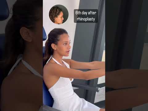 Rhinoplasty 6th Day Result in Turkey