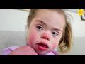 She Has Childhood Alzheimer S And Down Syndrome