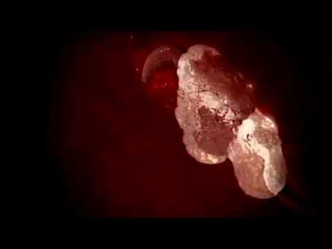 Medicina per vermi in 1 anno I parassiti in un corpo della persona per liberarsi il video