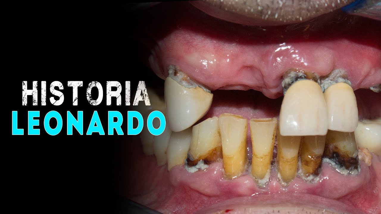 Watch ANTES Y DESPUES IMPLANTES 🎥📌 En 24 Horas cambio radical de SONRISA 😁😁 Now ANTES Y DESPUES IMPLANTES 🎥📌 En 24 Horas cambio radical de SONRISA 😁😁