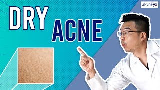 How To Treat Dry Skin + Acne (Dry Acne) | 5 Tips To Follow