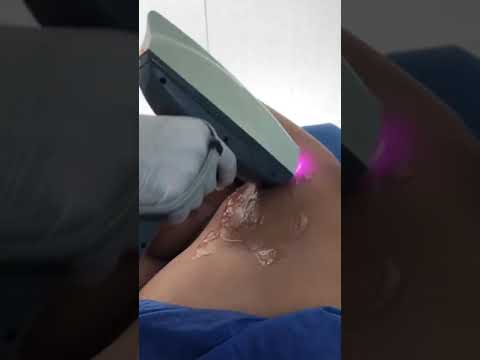 Depilación Láser en Cartagena: ¡Adiós al Vello para Siempre con el Dr. Rodrigo Vélez!