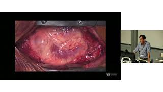 Anaortic Off-Pump CABG – Prof Michael Vallely