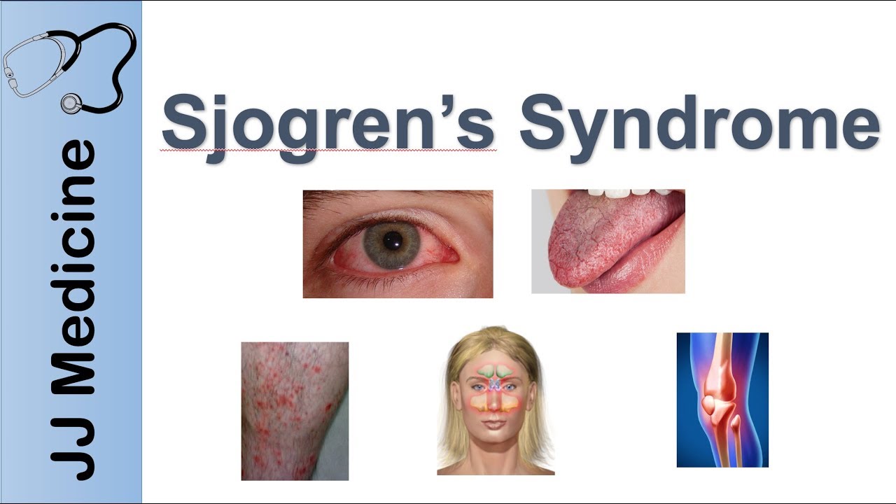 Sindrom Sjogren (