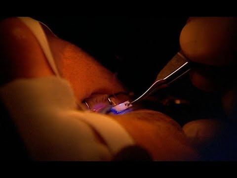 Pierścieniowanie rogówki - ratujące wzrok zabiegi także w Rzeszowie