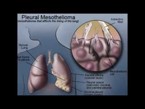 Mesothelioma Cure Diagnose Options