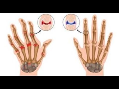 Tratamiento de la ciática Neck Osteocondrosis cervical qué ejercicios puede hacer