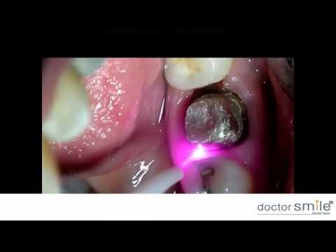 Doctor Smile Dental Laser diode gingival troughing