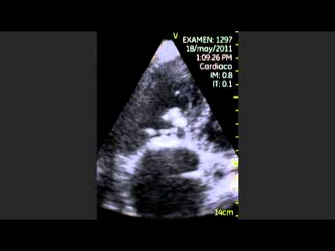 Tricuspid Valve Calcification