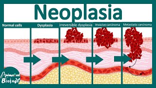Neoplasia | pathology underlying neoplasia | USMLE