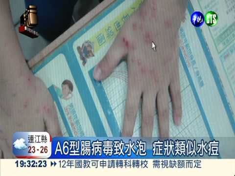 創7年高峰! 每天310人腸病毒急診