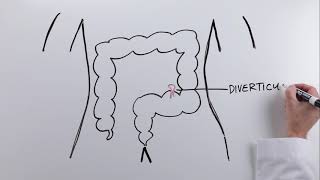 What is a sigmoidectomy