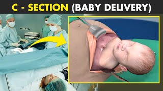 C-section (Cesarean Delivery) | How C-Section is Performed?