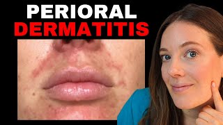 How to Treat Red Bumps Around the Mouth | Perioral Dermatitis