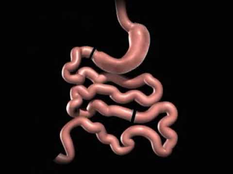 Overview of Biliopancreatic Diversion with Duodenal Switch (BPD/DS) Surgery