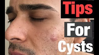Cysts: What causes them and How to Treat Them!