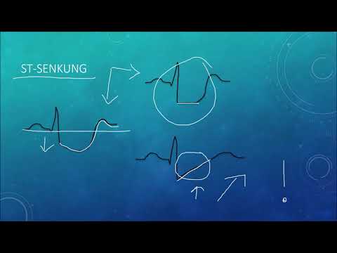 EKG Crashkurs, Teil 1: Die absoluten Grundlagen