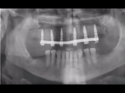Teeth in a Day with MIS V3 Implants
