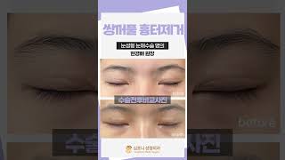 흉터 교정 수술 성형 시술